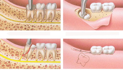 Nhổ răng khôn hàm dưới bao nhiêu tiền là thực hiện được? 3
