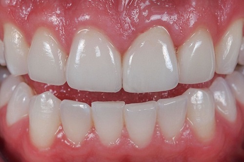 Răng sứ bị mòn mặt nhai - Nguyên nhân và cách khắc phục-1