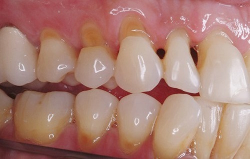 Răng sứ bị mòn mặt nhai - Nguyên nhân và cách khắc phục-2 Răng sứ bị mòn mặt nhai - Nguyên nhân và cách khắc phục-2