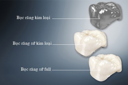 Răng sứ bị mòn mặt nhai - Nguyên nhân và cách khắc phục-3