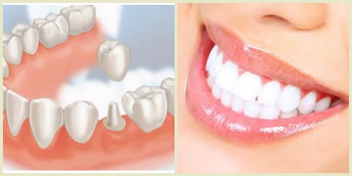 Răng sứ bị nhức - 5 nguyên nhân bạn nhất định phải biết 3