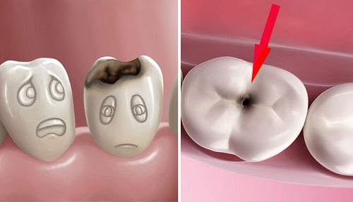 Răng sứ bị sâu có điều trị được không? Phải làm gì? 2 Răng sứ bị sâu có điều trị được không? Phải làm gì? 2