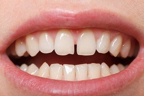 Tìm hiểu nguyên nhân gây răng sứ bị thưa và cách khắc phục 2
