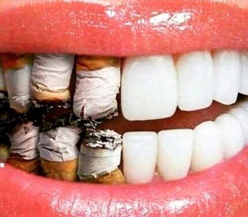 Tấy trắng răng hút thuốc có sao không? Tư vấn từ chuyên gia 2