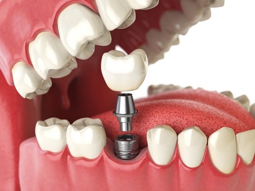 Trồng răng sứ có lâu không? Quy trình thực hiện-3