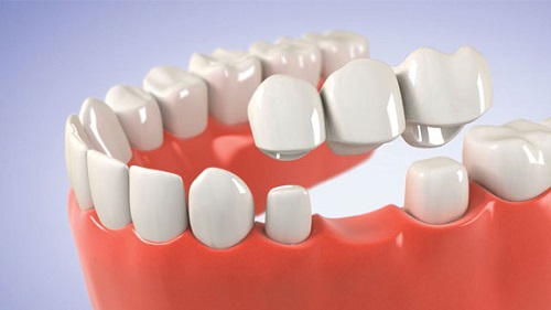 Trồng răng sứ có tốt không? Ưu điểm khi trồng răng sứ-2
