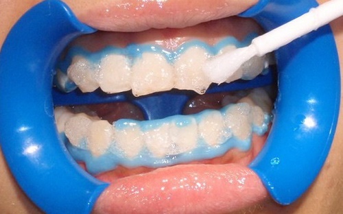 Tẩy trắng răng plasma có hại không? Tìm hiểu ngay 2