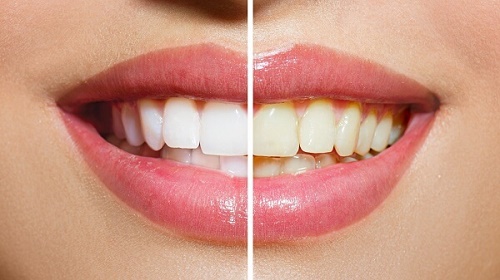 Tẩy trắng răng xong có được đánh răng không? 1