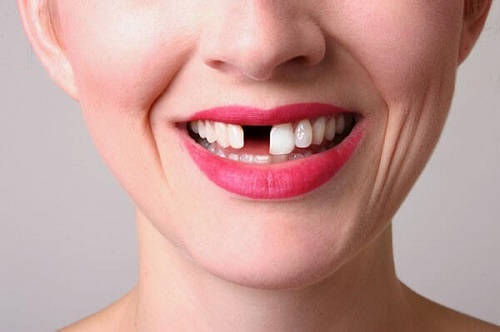 Trồng răng cửa hàm trên phục hình thẩm mỹ 1