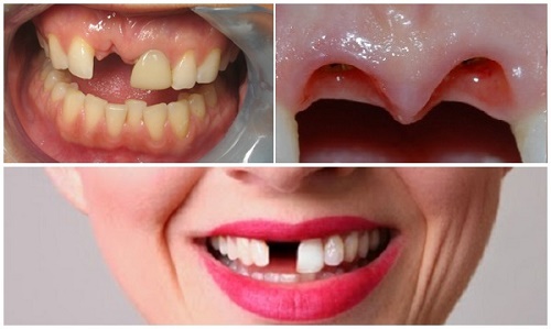 Trồng răng cửa mất bao lâu? Áp dụng kỹ thuật nào là phù hợp? 1