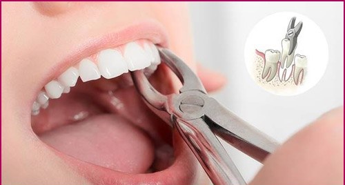 Nhổ răng mất bao nhiêu tiền? Cập nhật giá mới 2