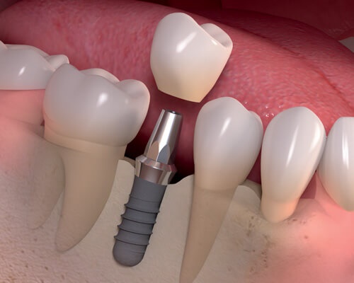 Trồng răng hàm implant giá bao nhiêu? Tìm hiểu giá cả 1