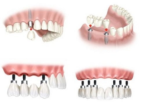 Trồng răng hàm implant giá bao nhiêu? Tìm hiểu giá cả 2