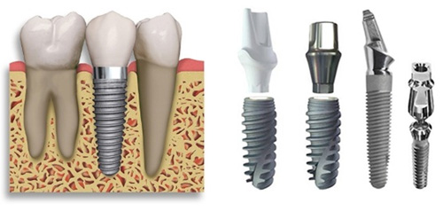 Trồng răng hàm implant giá bao nhiêu? Tìm hiểu giá cả 3