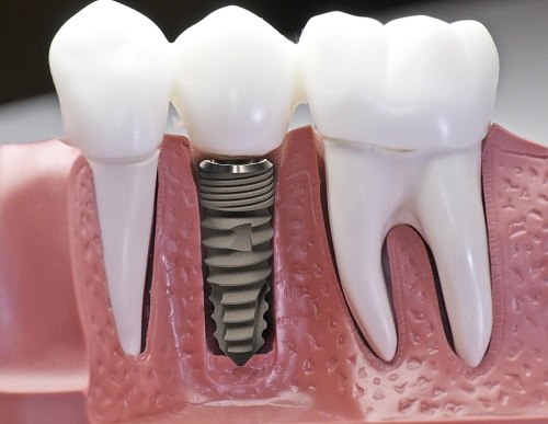 Trồng răng implant có đau không? Tìm hiểu về dịch vụ trồng răng 1