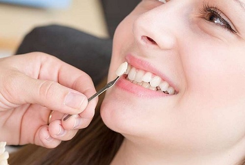 Trồng răng khểnh có đau không? Cách thực hiện 2