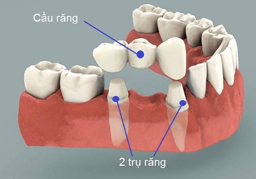 Trồng răng bằng cầu răng thực hiện ra sao? 1 Trồng răng bằng cầu răng thực hiện ra sao? 1