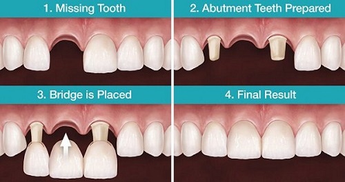 Trồng răng bằng cầu răng thực hiện ra sao? 2