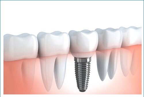 Trồng răng giả implant phục hình răng đã mất 1