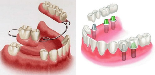 Trồng răng sứ cố định có tốt không? Tìm hiểu-2 Trồng răng sứ cố định có tốt không? Tìm hiểu-2