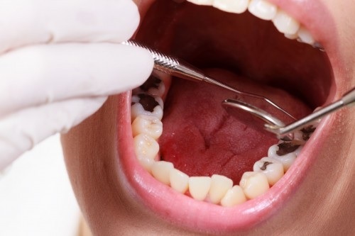 Trám răng mất bao nhiêu thời gian? Có lâu không? 1