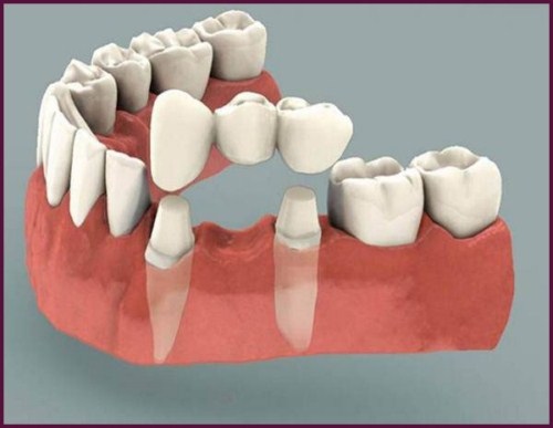 Trồng răng có nhanh không? Phụ thuộc các yếu tố nào? 3 Trồng răng có nhanh không? Phụ thuộc các yếu tố nào? 3