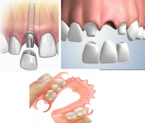 Trồng răng cửa hàm dưới - Tìm hiểu phương pháp trồng răng 1