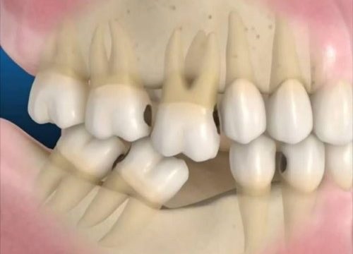 Trồng răng giả có lâu không? Phụ thuộc vào yếu tố nào? 1