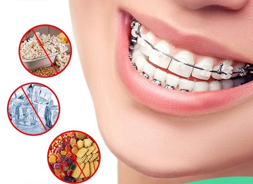 Niềng răng ăn uống như thế nào để có kết quả tốt nhất? 3