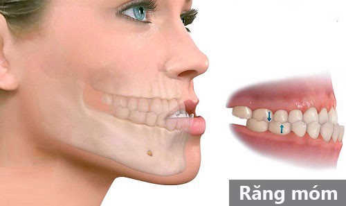 Niềng răng móm trong bao lâu là có kết quả? 1