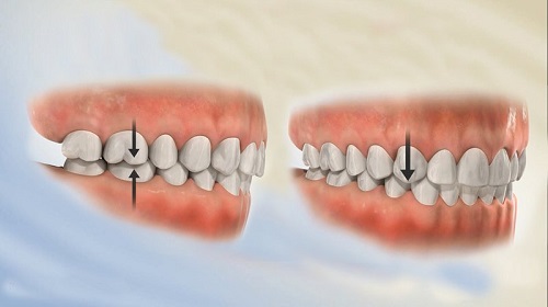 Niềng răng chỉnh hàm lệch hiệu quả thế nào? 1