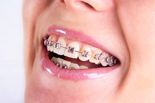 Niềng răng chỉnh hàm lệch hiệu quả thế nào? 2