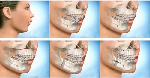 Niềng răng chỉnh hàm lệch hiệu quả thế nào? 3