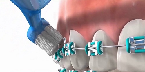 Niềng răng chỉnh hàm lệch hiệu quả thế nào? 4
