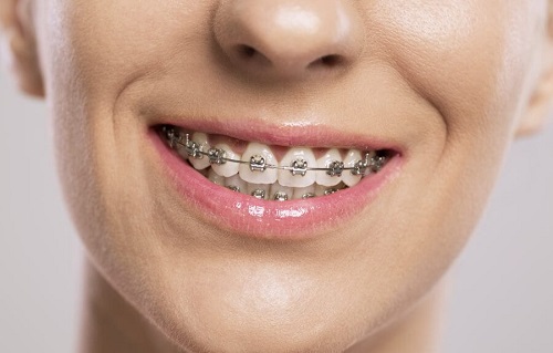 Niềng răng có ảnh hưởng đến sức khỏe không? Tư vấn miễn phí 1