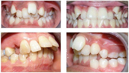 Niềng răng không đều - Phương pháp khắc phục hiệu quả 1