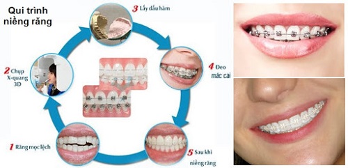 Niềng răng không đều - Phương pháp khắc phục hiệu quả 2
