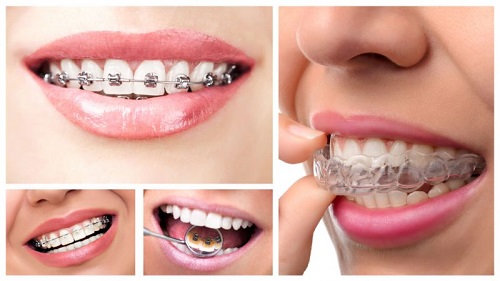 Niềng răng không đều - Phương pháp khắc phục hiệu quả 3 Niềng răng không đều - Phương pháp khắc phục hiệu quả 3