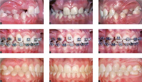 Niềng răng không đều - Phương pháp khắc phục hiệu quả 4