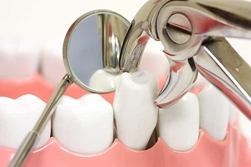 Niềng răng phải nhổ răng nào? Chuyên gia giải đáp 3