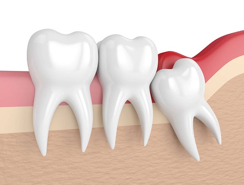 Răng khôn bị sâu chảy máu - Cách điều trị phù hợp 1