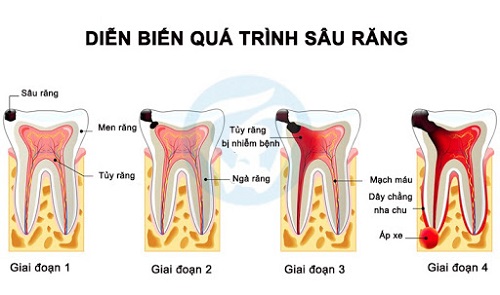 Quy trình điều trị tủy răng sữa cho trẻ em 2