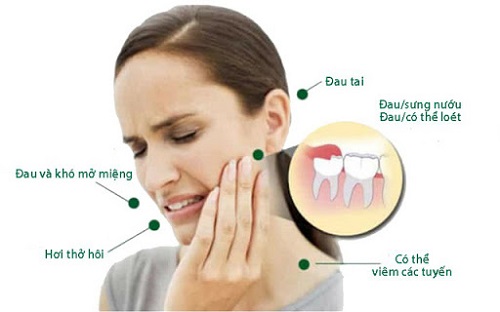 Răng khôn làm lệch mặt - Phương pháp điều trị từ nha khoa 2