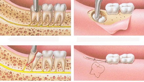 Răng khôn làm lệch mặt - Phương pháp điều trị từ nha khoa 3