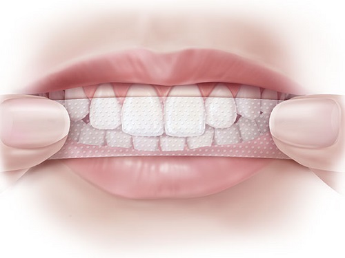 Sản phẩm làm trắng răng an toàn - Top 3 sản phẩm cho bạn 1