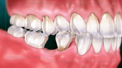 Mất răng lâu năm có trồng được không? Tìm hiểu cách phục hình 1