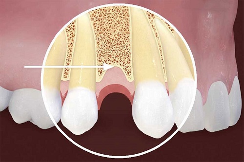 Mất răng lâu năm có trồng được không? Tìm hiểu cách phục hình 2 Mất răng lâu năm có trồng được không? Tìm hiểu cách phục hình 2