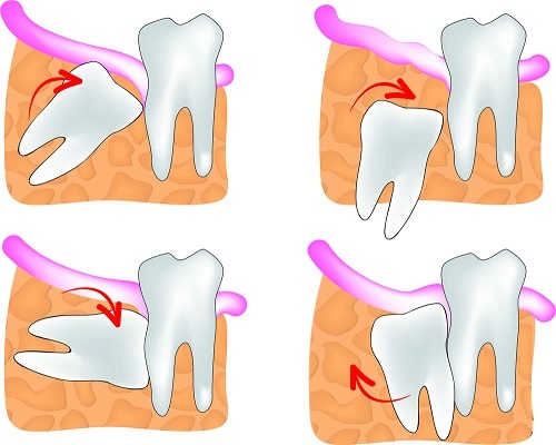 Mọc 4 cái răng khôn cùng lúc - Ảnh hưởng sức khỏe không? 2