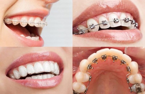 Niềng răng ăn cháo bao lâu là được? Cần lưu ý gì? 3 Niềng răng ăn cháo bao lâu là được? Cần lưu ý gì? 3