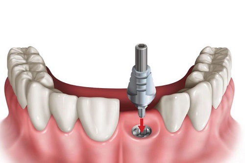 Trồng răng bị rụng với kỹ thuật tốt tại nha khoa 2